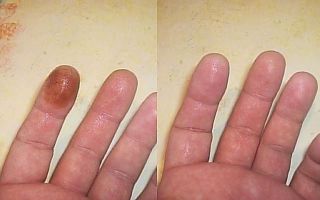 How to wash potassium permanganate from the skin of hands and face